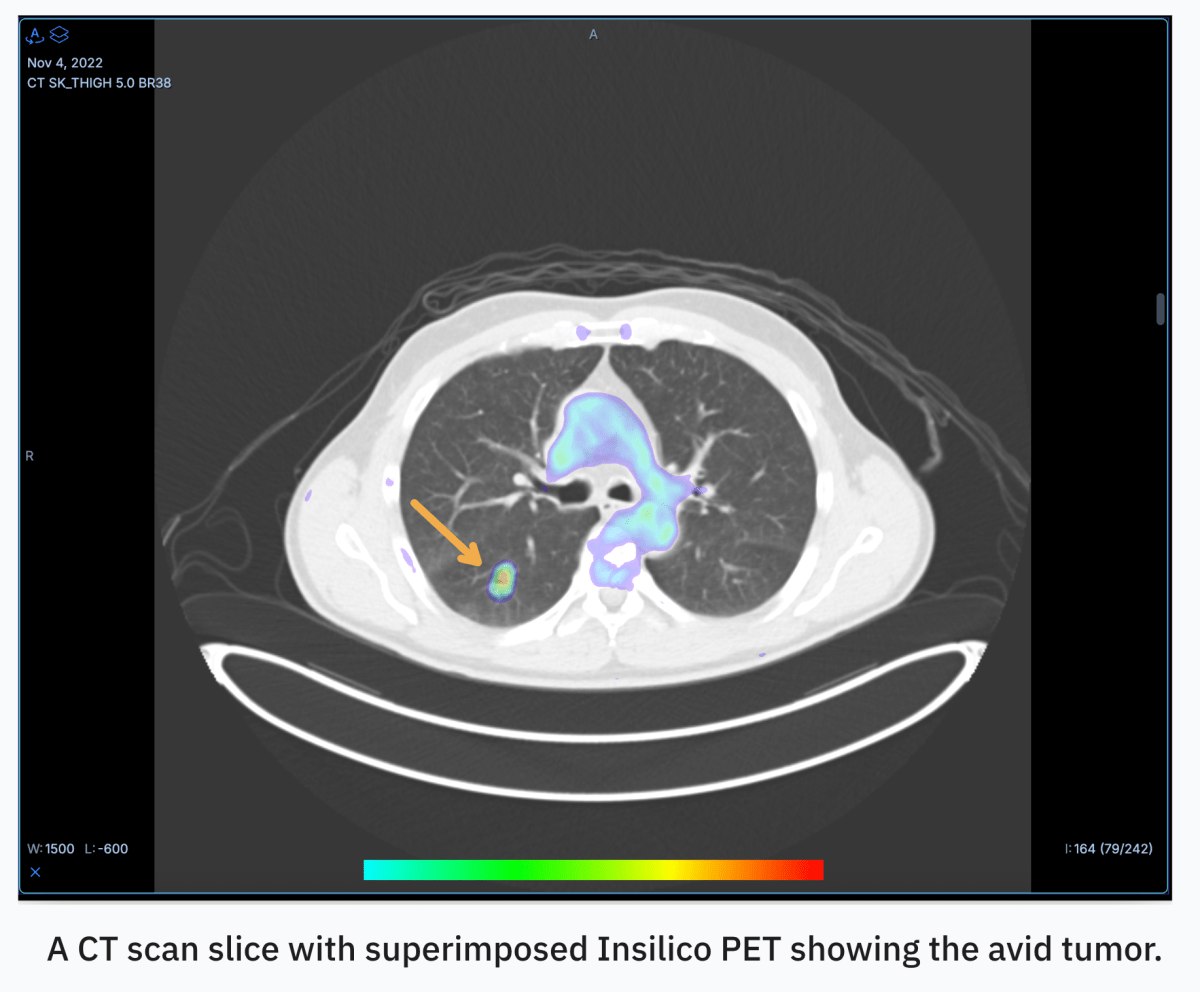 انقلاب هوش مصنوعی در تشخیص سرطان: تبدیل CT به PET
